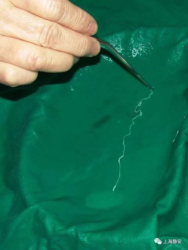 Chàng trai 28 tuổi bị ăn mất não, bác sĩ nói nguyên nhân khiến người cha lập tức hối hận-3