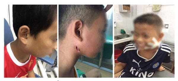 Nghệ An: Sức khỏe 3 bệnh nhi nhiễm vi khuẩn ăn thịt người chuyển biến tốt-1