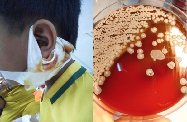 Nghệ An: Sức khỏe 3 bệnh nhi nhiễm vi khuẩn ăn thịt người chuyển biến tốt-2