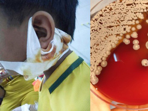 Vì thói quen đi chân trần trong phòng tắm mà người đàn ông này bị vi khuẩn ăn thịt người tấn công-6