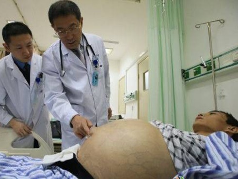 4 anh em ruột cùng bị ung thư gan, 3 người đã tử vong vì phạm sai lầm này khi mắc bệnh-3