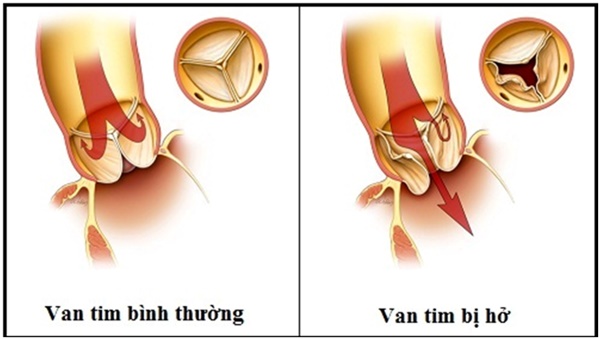 Bệnh hở van tim khiến Tuấn Hưng đang phải nằm viện theo dõi có nguy hiểm không?-4