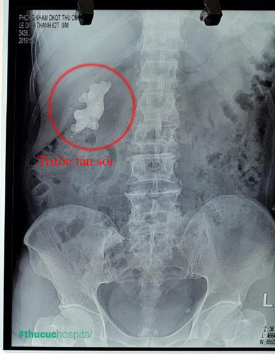 Cứu quả thận mắc sỏi san hô 7cm không cần mổ mở-1