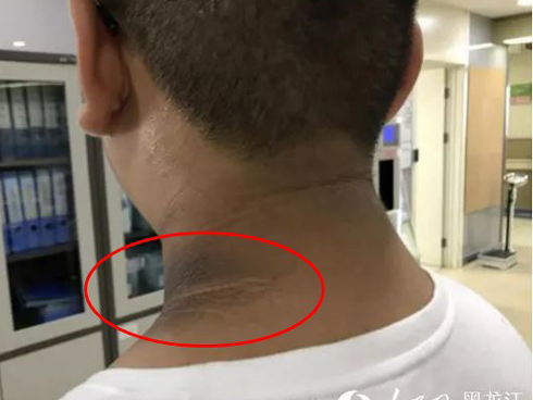 Cổ con trai có vết đen xì không thể kì sạch, mẹ đưa đi khám mới tá hỏa vì căn bệnh tưởng chỉ người lớn mắc