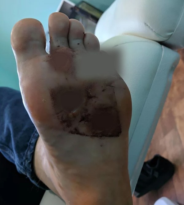 Vì thói quen đi chân trần trong phòng tắm mà người đàn ông này bị vi khuẩn ăn thịt người tấn công-2