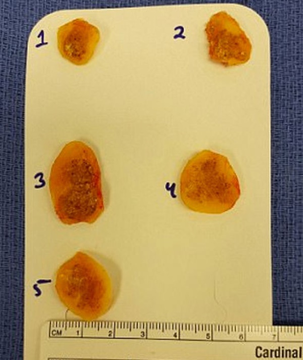 Vì thói quen đi chân trần trong phòng tắm mà người đàn ông này bị vi khuẩn ăn thịt người tấn công-3