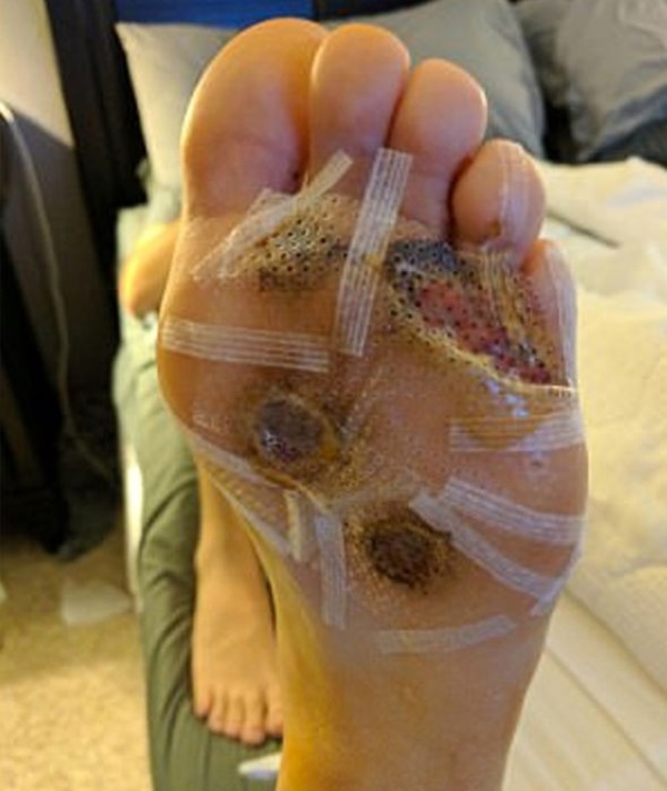 Vì thói quen đi chân trần trong phòng tắm mà người đàn ông này bị vi khuẩn ăn thịt người tấn công-4