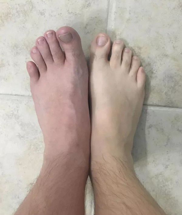 Vì thói quen đi chân trần trong phòng tắm mà người đàn ông này bị vi khuẩn ăn thịt người tấn công-5