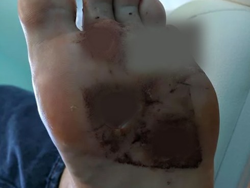 Bé 4 tuổi suýt chết vì nhiễm trùng máu do vi khuẩn ăn thịt người dễ lây qua hắt hơi-5