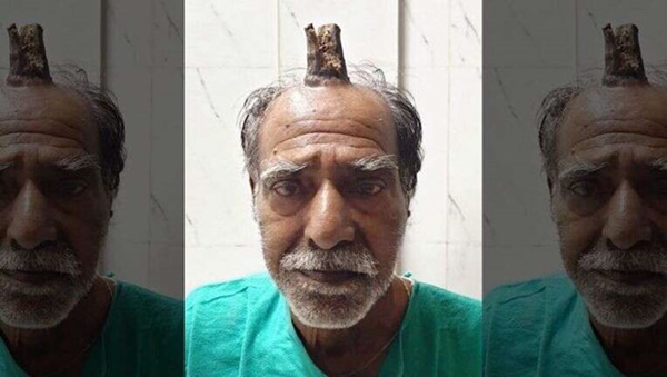 Cắt bỏ sừng ác quỷ dài gần 10 cm trên đầu người đàn ông Ấn Độ-1