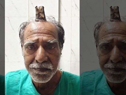 Cắt bỏ 'sừng ác quỷ' dài gần 10 cm trên đầu người đàn ông Ấn Độ