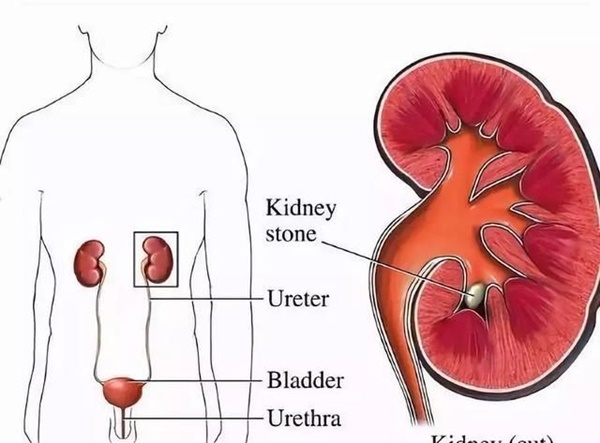 Người mẹ đang cho con bú phải cắt thận trái, thủ phạm là thói quen nhiều người mắc-2