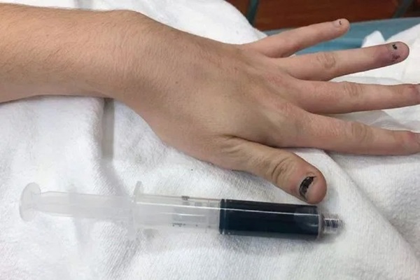 Một người phụ nữ có máu bỗng biến thành màu xanh sau khi dùng kem gây tê để chữa đau răng-1