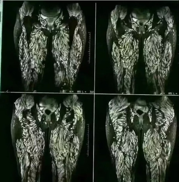 Người phụ nữ bị sán làm tổ kín cả hai chân và phần nhạy cảm chỉ vì thích ăn gỏi-1