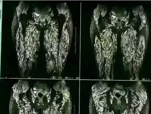 Người phụ nữ bị sán làm tổ kín cả hai chân và