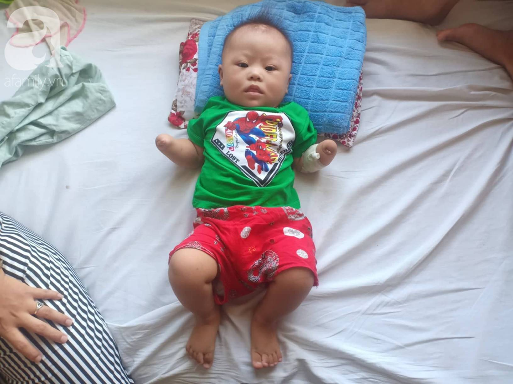 Tâm sự đau đớn của người mẹ khi sinh con trai không có 2 tay: Tôi đã sốc khi lần đầu nhìn thấy hình hài con mình-6