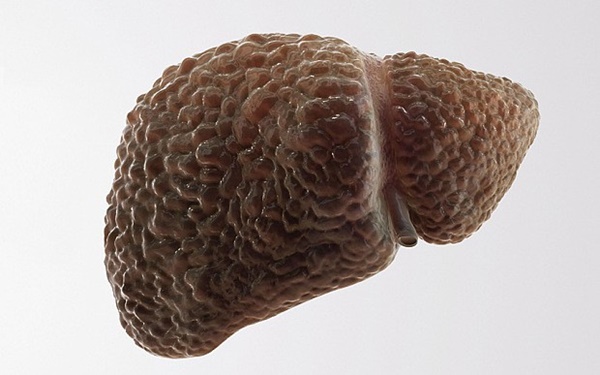 4 anh em ruột cùng bị ung thư gan, 3 người đã tử vong vì phạm sai lầm này khi mắc bệnh-2