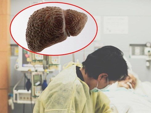 4 anh em ruột cùng bị ung thư gan, 3 người đã tử vong vì phạm sai lầm này khi mắc bệnh