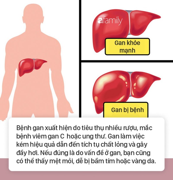 Tình trạng bụng đầy hơi có thể là dấu hiệu cảnh báo 6 bệnh nguy hiểm mà nhiều người không biết-2