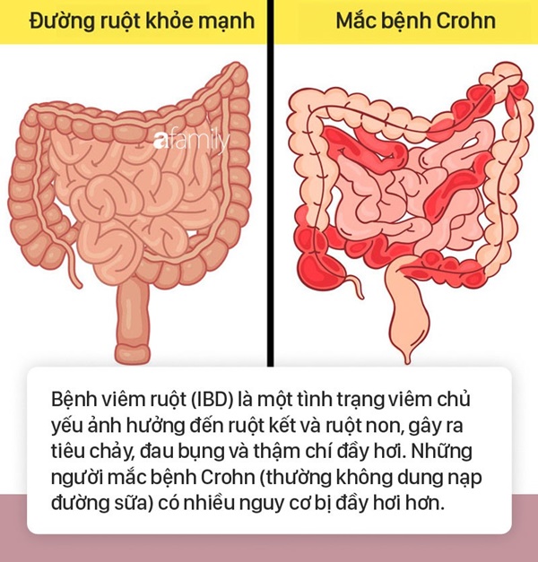 Tình trạng bụng đầy hơi có thể là dấu hiệu cảnh báo 6 bệnh nguy hiểm mà nhiều người không biết-3