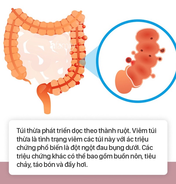 Tình trạng bụng đầy hơi có thể là dấu hiệu cảnh báo 6 bệnh nguy hiểm mà nhiều người không biết-4