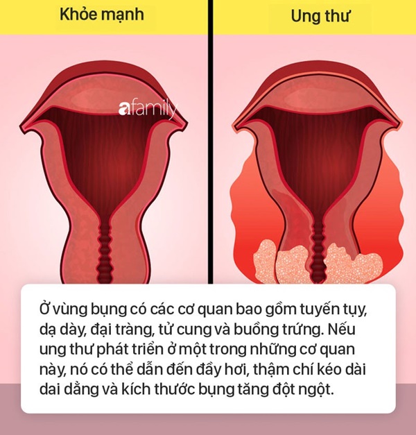 Tình trạng bụng đầy hơi có thể là dấu hiệu cảnh báo 6 bệnh nguy hiểm mà nhiều người không biết-5