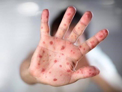 Hà Nội ghi nhận gần 600 trường hợp mắc tay chân miệng