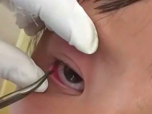 Phẫu thuật lấy con vắt từ mắt bé gái