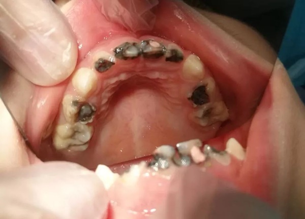 Đưa con 5 tuổi đi khám, bé vừa há miệng ra đã khiến bác sĩ phải kinh ngạc-1