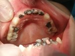 Con trai suýt chết vì một chiếc răng đau, mẹ đau lòng cảnh báo: Hãy dạy trẻ cách đánh răng-3