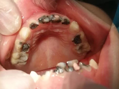 Đưa con 5 tuổi đi khám, bé vừa há miệng ra đã khiến bác sĩ phải kinh ngạc