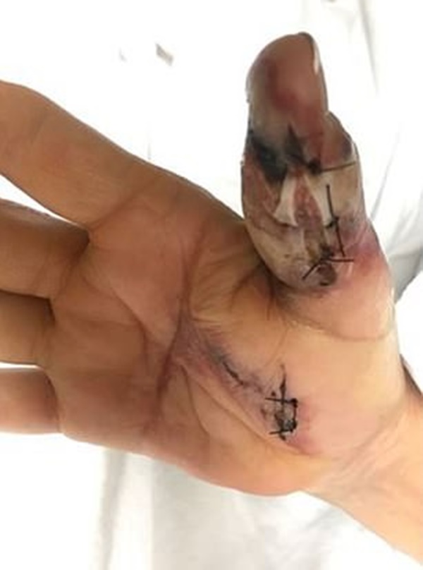 Đi làm móng ở spa, người phụ nữ bị nhiễm vi khuẩn ăn thịt người và phải cắt bỏ 1 phần ngón tay cái-2