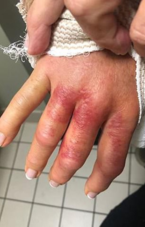 Đi làm móng ở spa, người phụ nữ bị nhiễm vi khuẩn ăn thịt người và phải cắt bỏ 1 phần ngón tay cái-4