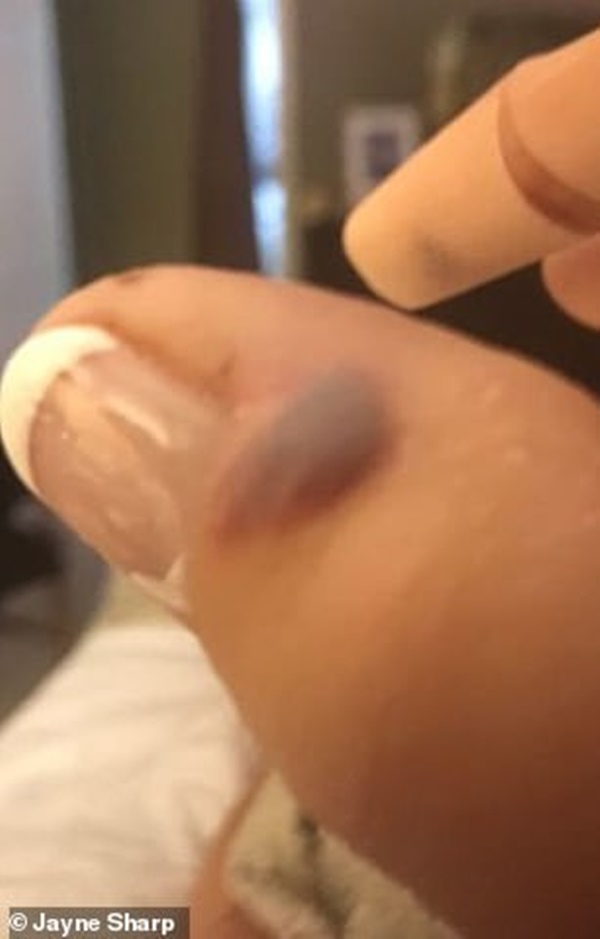 Đi làm móng ở spa, người phụ nữ bị nhiễm vi khuẩn ăn thịt người và phải cắt bỏ 1 phần ngón tay cái-5