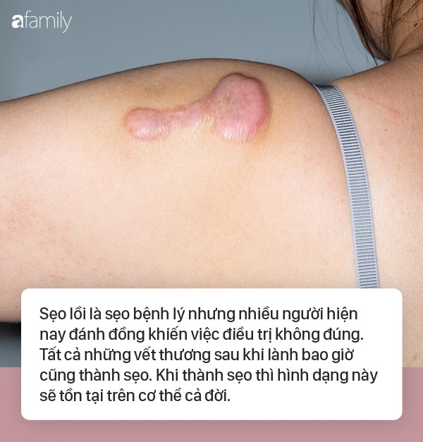 Không phải cứ thấy sẹo lồi lên là tiêm ngay để điều trị, chuyên gia cảnh báo điều mà hầu hết mọi người đang nhầm lẫn-2