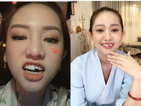 Thúy Vi bất ngờ rút túi nâng ngực, antifan cà khịa: Rồi có tháo luôn mấy chỗ sửa trên mặt không?-17