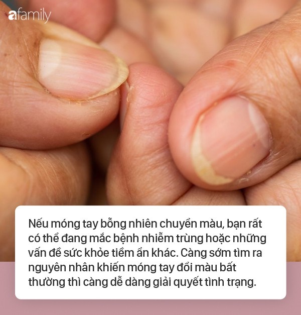 Móng tay vàng là dấu hiệu cảnh báo những vấn đề sức khỏe: Bạn có thể không biết, móng tay của bạn có thể cảnh báo về các vấn đề sức khỏe nghiêm trọng. Khi các móng tay xuất hiện dấu hiệu màu vàng, hãy đến bác sĩ để tìm hiểu và chăm sóc sức khỏe của bạn.