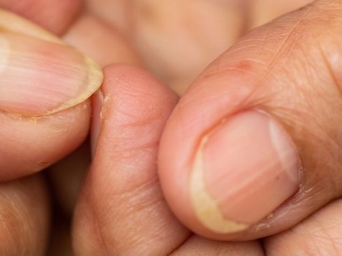 Những dấu hiệu từ móng tay cảnh báo ung thư hoặc gan sắp hỏng-3