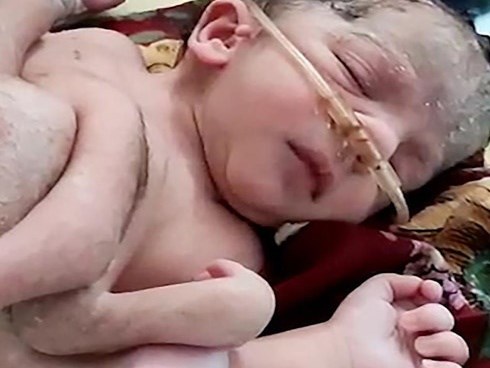 Em bé Ấn Độ chào đời với 4 chân và 3 tay