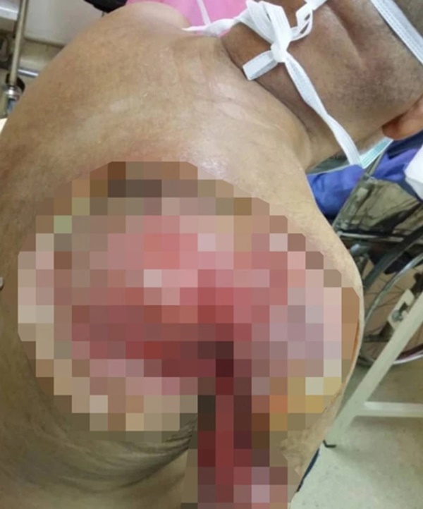 Uống 2 chai nước ngọt mỗi ngày, cánh tay người đàn ông thối rữa, hoại tử-3