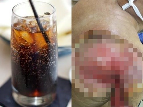Uống 2 chai nước ngọt mỗi ngày, cánh tay người đàn ông thối rữa, hoại tử