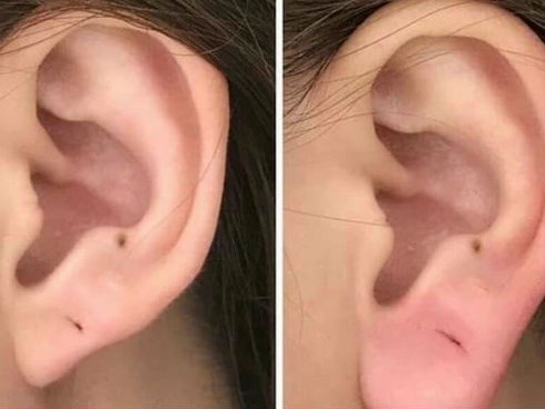 Dịch vụ tiêm tai tài lộc đang khiến chị em điên đảo thực chất là phương pháp thẩm mỹ gì?