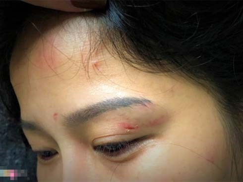 Nạn nhân bị chồng cũ đánh: Ly hôn rồi anh ta vẫn dọa giết tôi