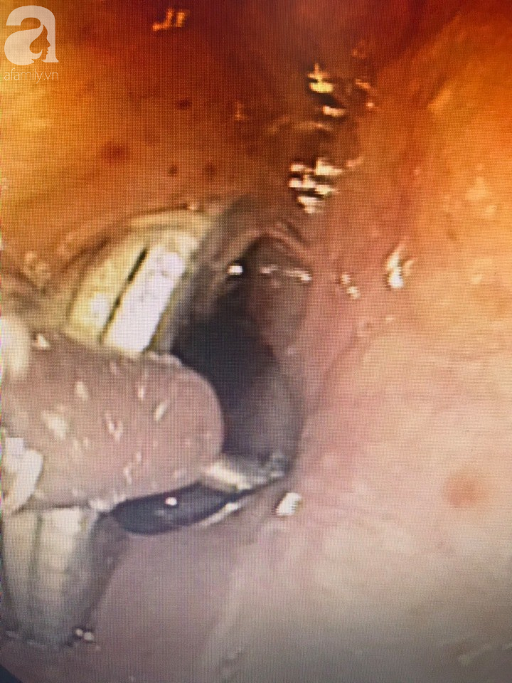 Thấy con ói ra máu, cha mẹ đưa đi viện thì phát hiện bé trai 4 tuổi nguy kịch vì thứ rất sắc nhọn này-2