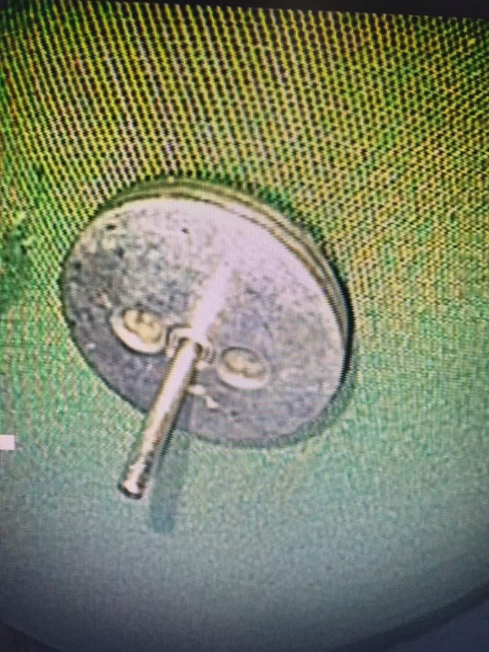 Thấy con ói ra máu, cha mẹ đưa đi viện thì phát hiện bé trai 4 tuổi nguy kịch vì thứ rất sắc nhọn này-3