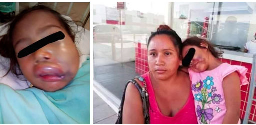 Đón con từ trường mẫu giáo, mẹ sốc nặng khi thấy môi con sưng phồng biến dạng, mặt mày thâm tím, nghe cô giáo giải thích càng thêm phẫn nộ-1