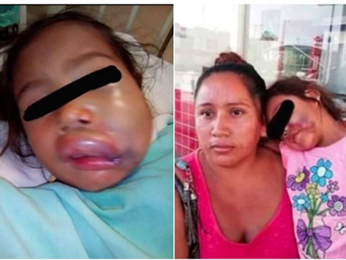 Đón con từ trường mẫu giáo, mẹ sốc nặng khi thấy môi con sưng phồng biến dạng, mặt mày thâm tím, nghe cô giáo giải thích càng thêm phẫn nộ