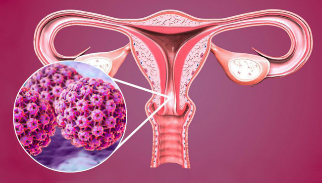 Bác sĩ mách chị em phụ nữ cách đúng nhất để biết mình có đang bị ung thư cổ tử cung hay không-1