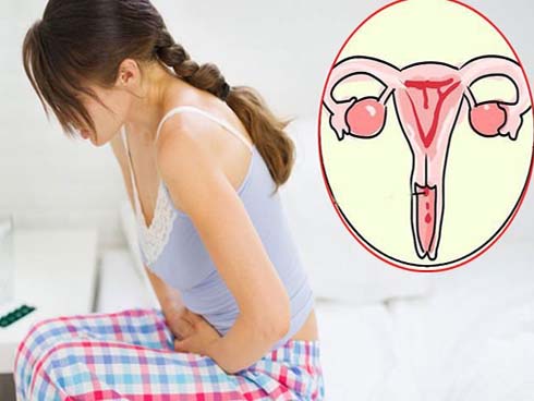 Không có biểu hiện bất thường, chỉ đôi lúc có ra khí hư màu vàng, người phụ nữ không ngờ mình bị ung thư cổ tử cung-3