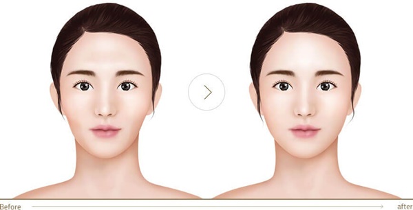 Làm đẹp bằng cách tiêm mỡ tự thân sẽ không trở thành nỗi ác mộng kinh hoàng nếu bạn nhớ 5 điều quan trọng này từ chuyên gia-1